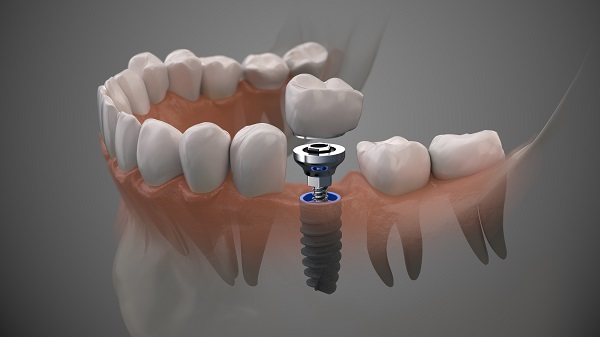 Dental Implants Winston-Salem, NC