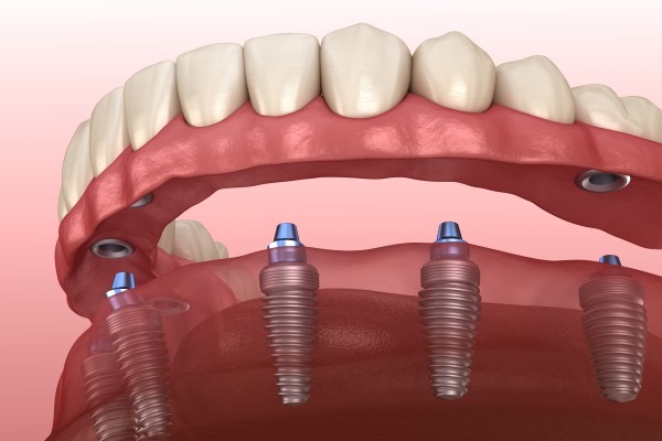 Full Mouth Dental Implants For Bottom Teeth Replacement