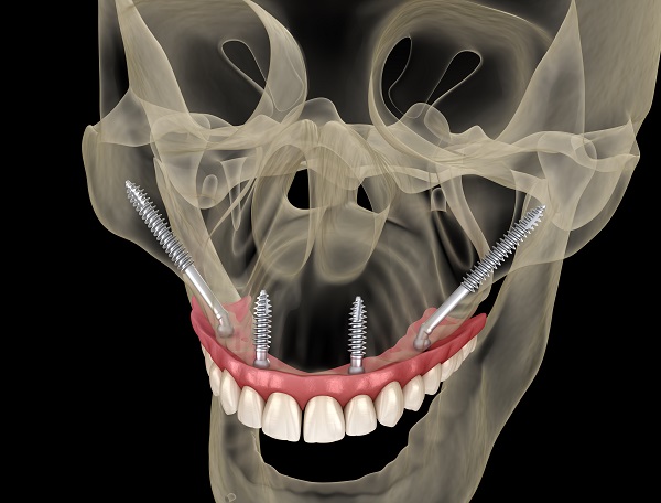 Implant Supported Dentures Winston-Salem, NC