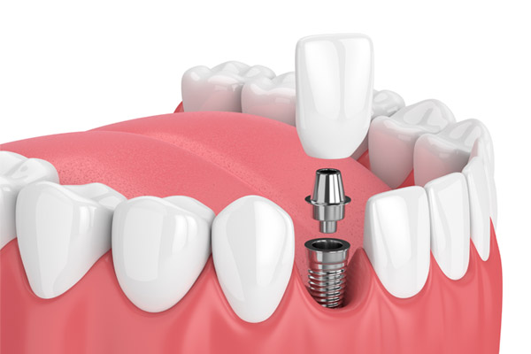 Prerequisites for Getting Dental Implants from Dental Center of the Carolinas in Winston-Salem, NC